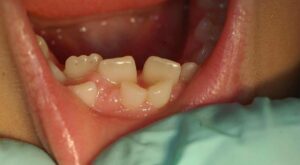 shark-teeth-children